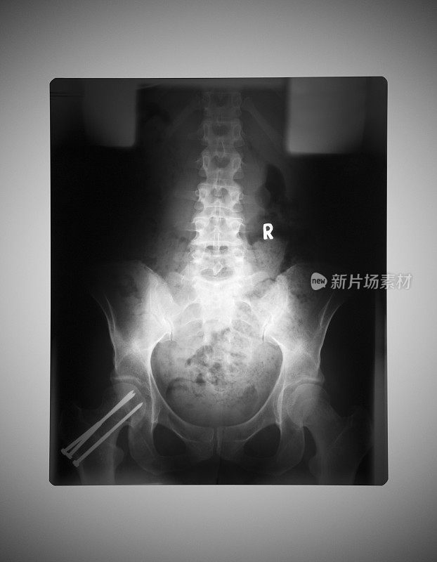 人体臀部的医学x光片在医生的灯箱上