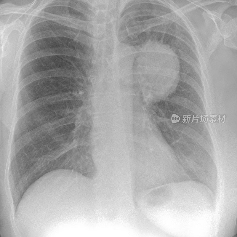 一位女性肺癌吸烟者的胸部x光片
