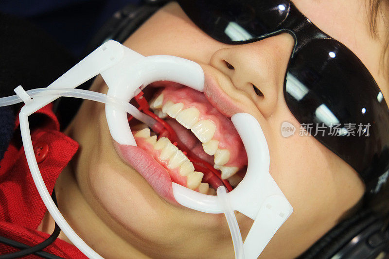 孩子在看牙医准备戴牙套