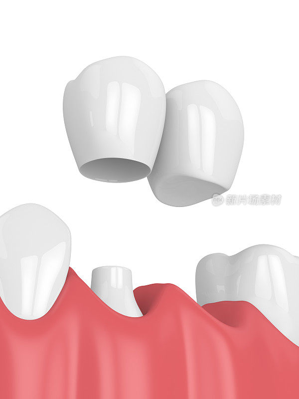 3d渲染颌骨与牙科悬臂桥