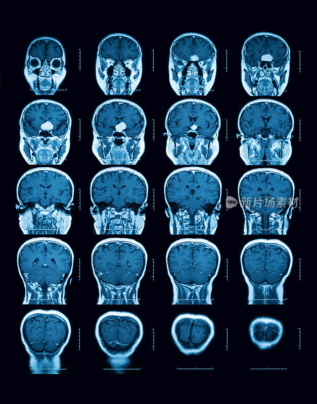 磁共振成像(MRI)扫描大脑，冠状视图。