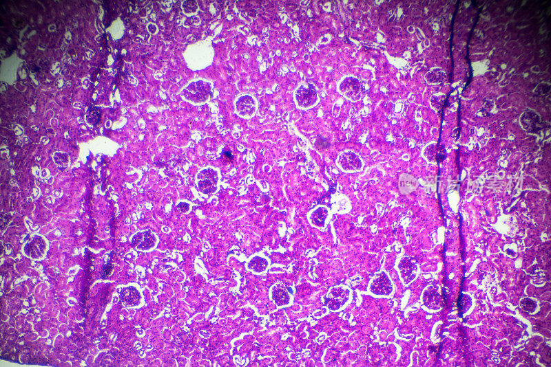 显微镜下急性肾盂肾炎活检标本
