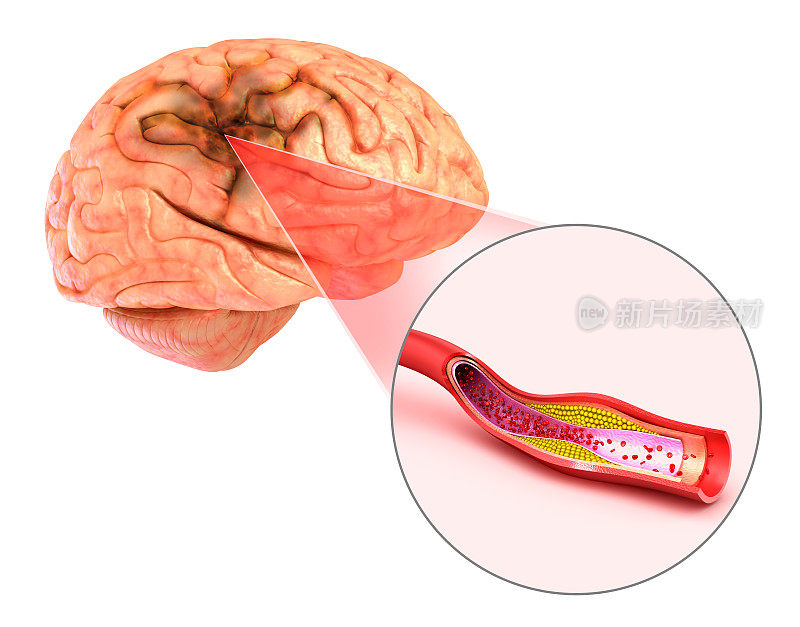 脑卒中:脑血管的3d插图和中风的原因