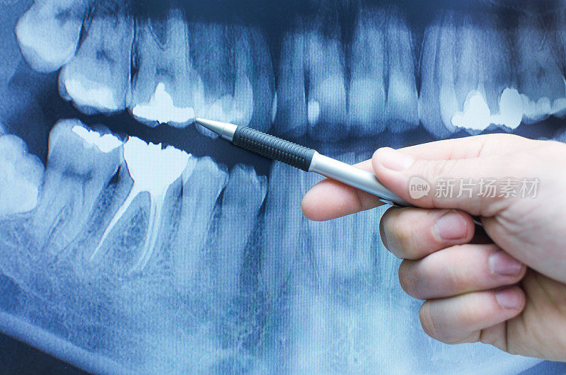 牙科医生在牙科x光图像上显示了一些东西