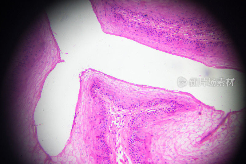 显微镜下呈层状鳞状上皮