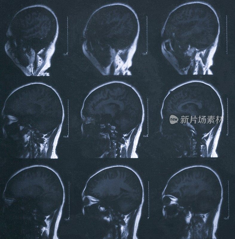 MRI扫描人类头部胶片
