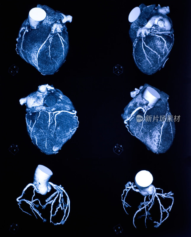 冠状动脉造影的多探测器计算机断层扫描