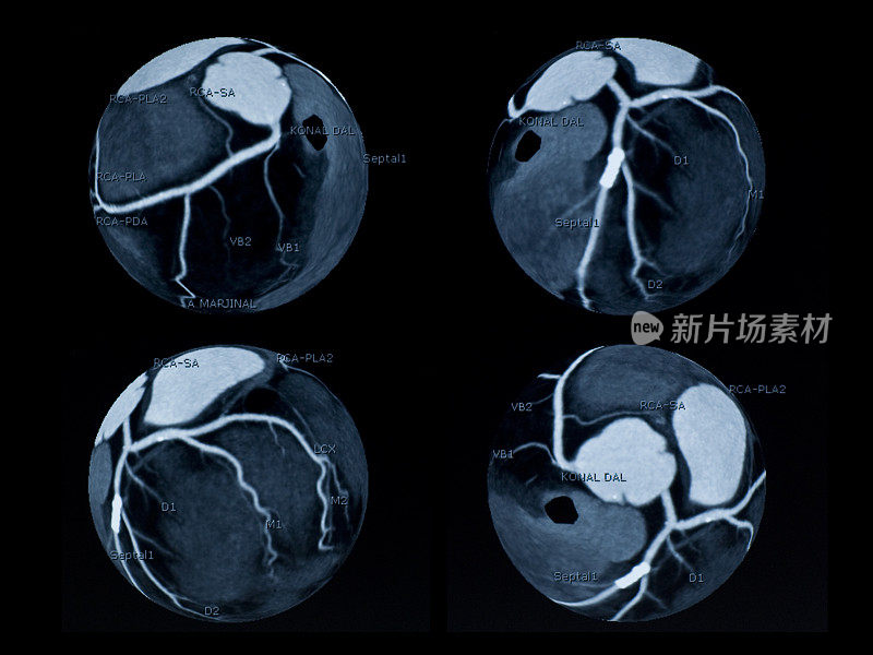 冠状动脉造影