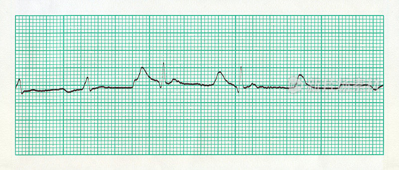 图表心电图(ECG)