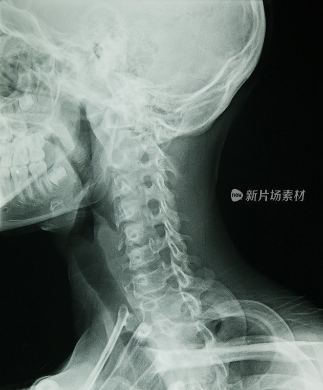 颈部和颈椎x光片
