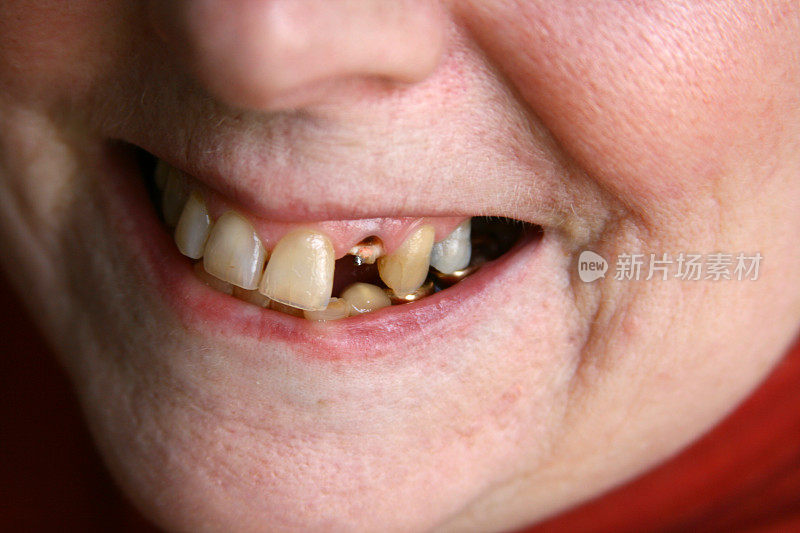 快打电话给牙医:缺牙的女人