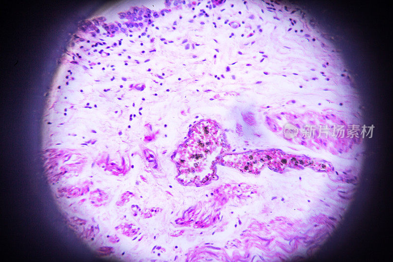 显微镜下的输尿管结石