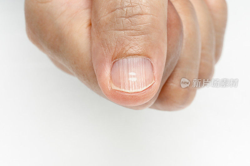 指甲上有白色斑点和竖脊症状