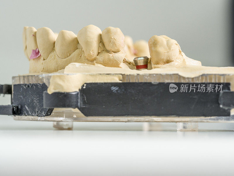 种植复制品在一个铸型牙科