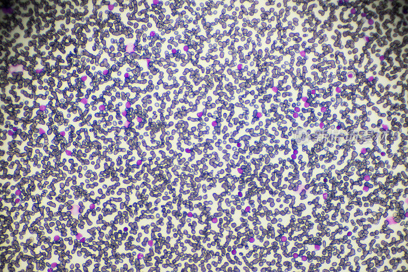 光镜下急性淋巴母细胞白血病ALL-L3血液涂片