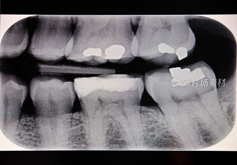 牙齿x射线图像