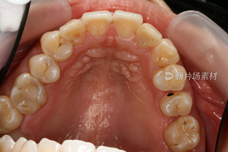 18个月后矫正牙齿(俯视图)