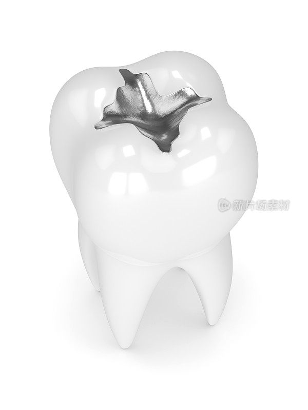 牙齿的3d渲染与牙科汞合金填充