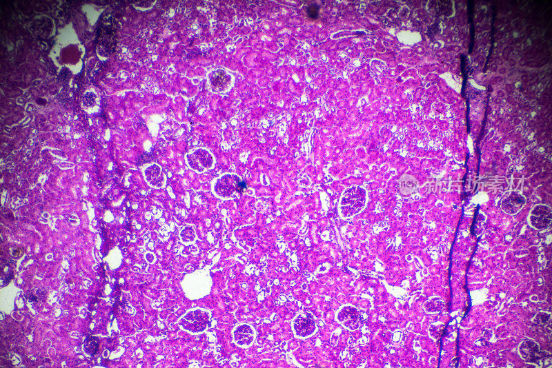 显微镜下急性肾盂肾炎活检标本
