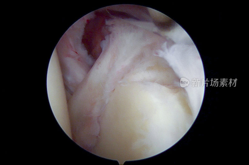 肩关节镜检查显示近端唇瓣撕裂