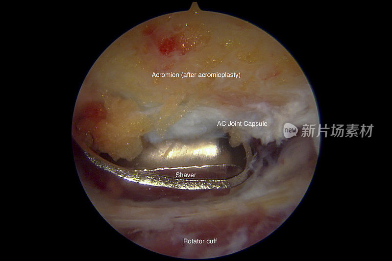 左肩锁关节和软组织切除治疗AC骨关节炎的关节镜视图