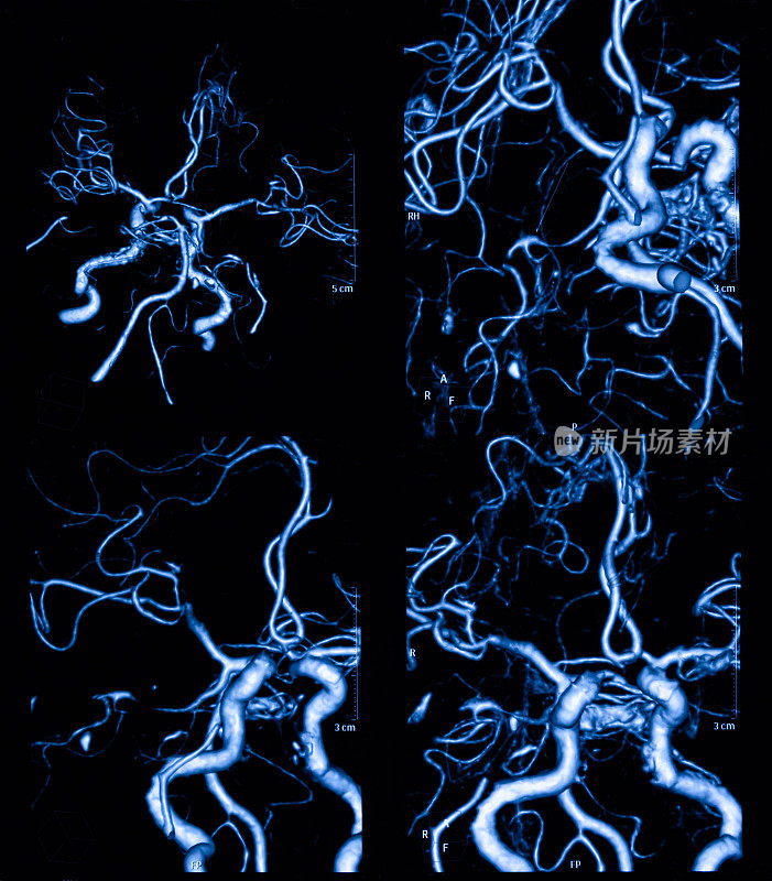 MRI扫描人类大脑动脉断层扫描