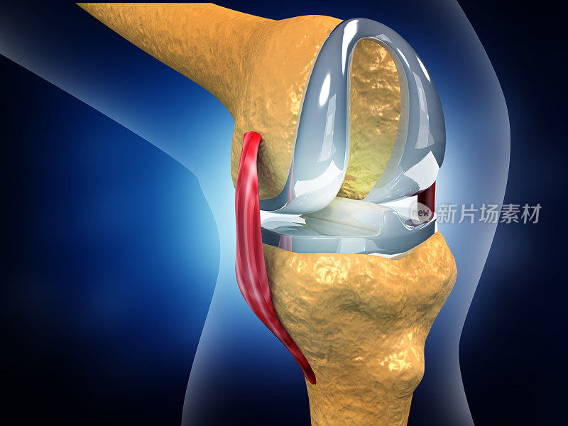 人体膝关节置换术植入物