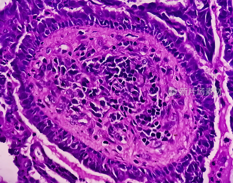 对子宫内膜(子宫)癌的认识:子宫活检显示子宫内膜癌或子宫内膜癌的显微照片。