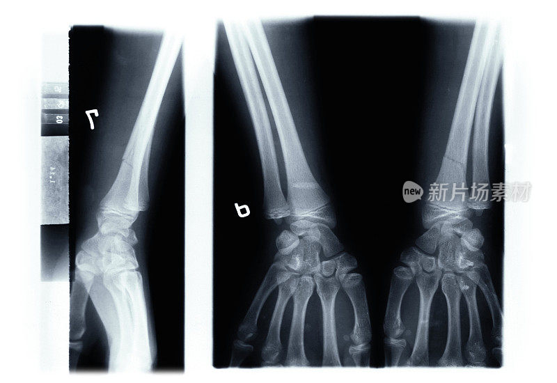 手部x光片