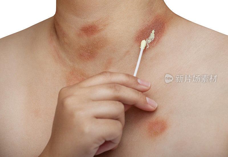 1人与玫瑰糠疹疾病的胸部和颈部在一个孤立的背景。