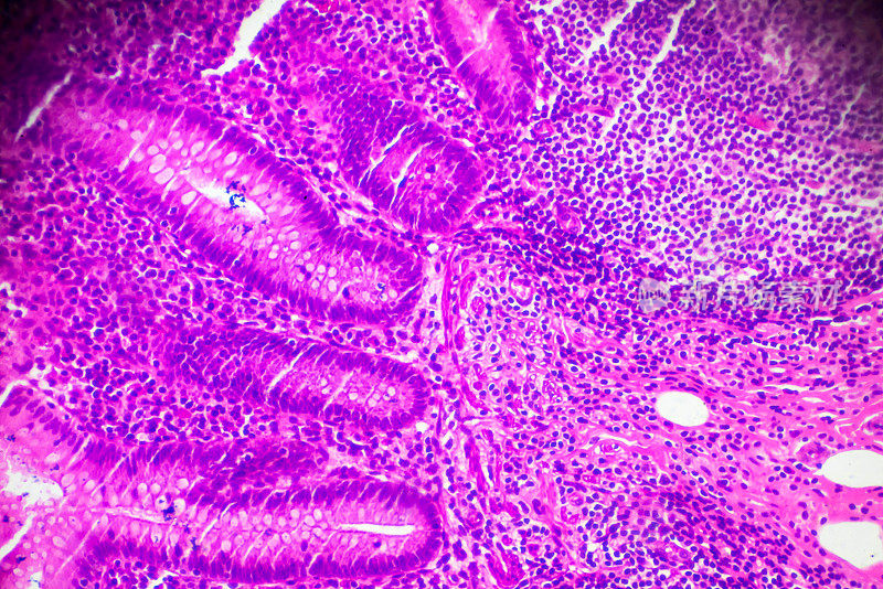 慢性阑尾炎光镜下病理分析