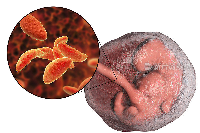 刚地弓形虫寄生虫传播给胎儿的医学概念