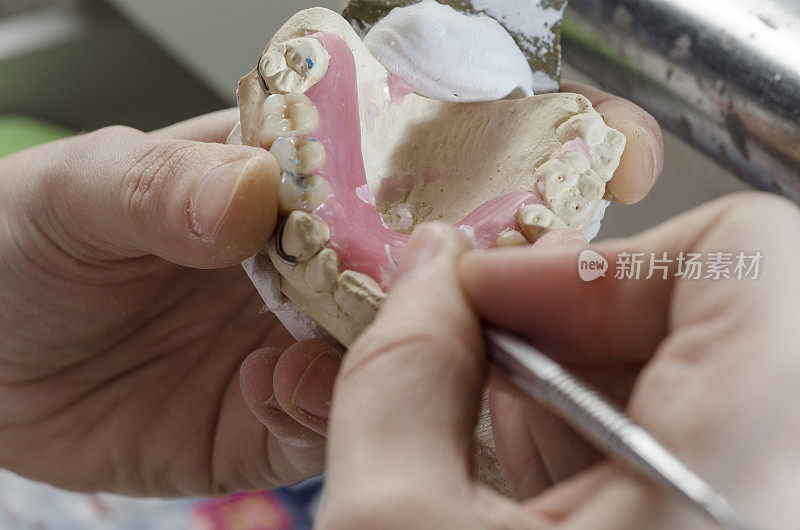 牙科技师用丙烯酸树脂做局部假牙。