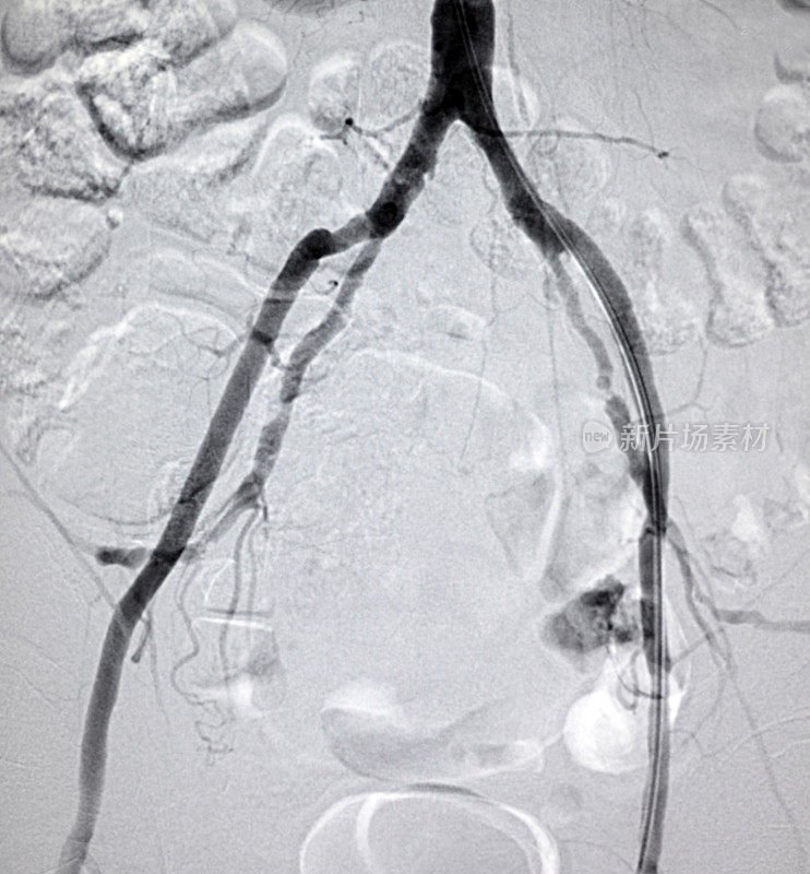 髂内动脉粥样硬化DSA图像