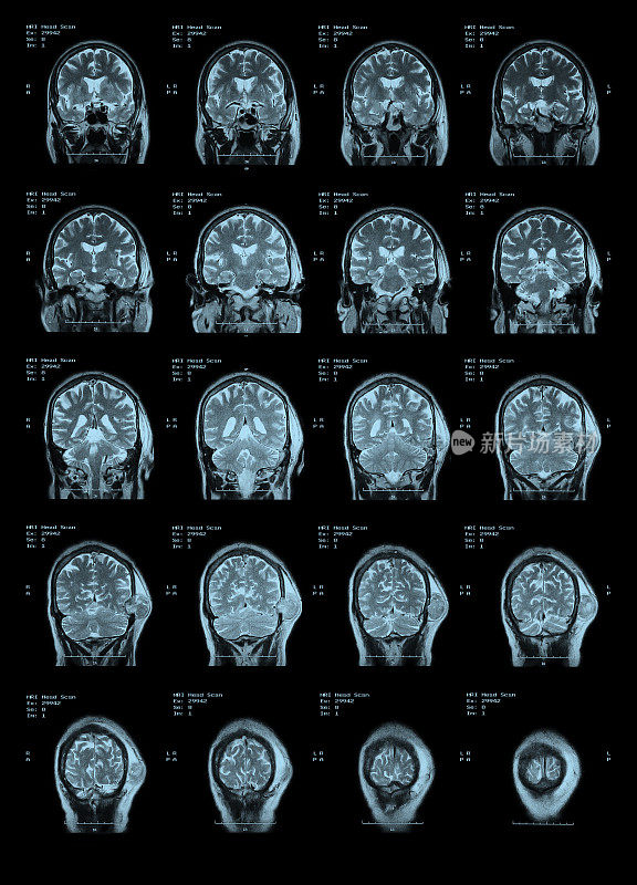 MRI头部扫描后视图。
