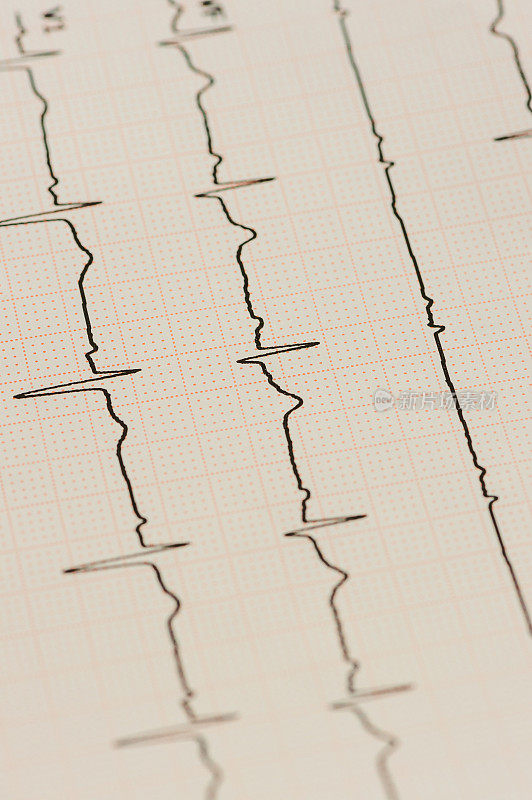 图表心电图(ECG)