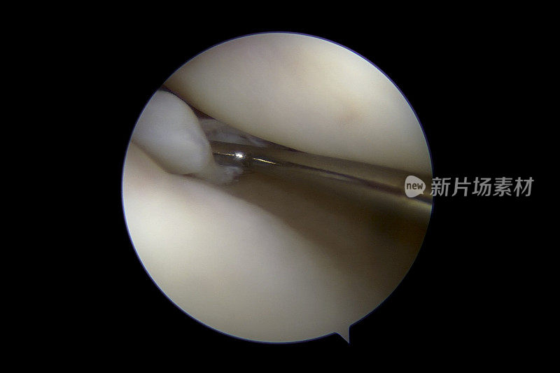 右膝关节内侧室半月板撕裂的关节镜照片
