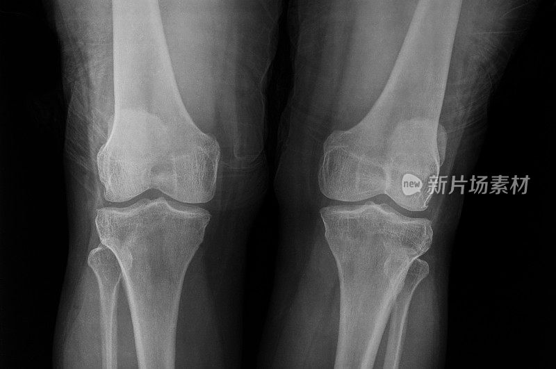 膝关节x线图像