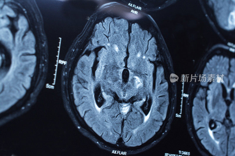 从事医学研究。病人的CT扫描。