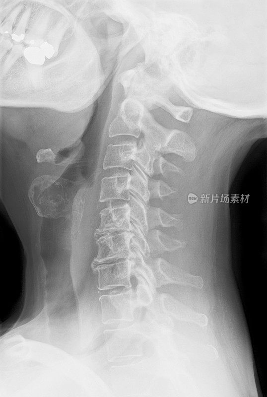 引起颈痛的颈椎病的x光片