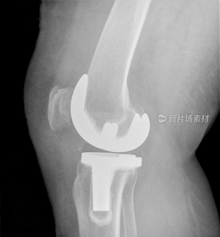 膝关节置换手术成功后的数字x光