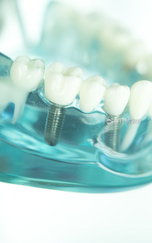 牙科医生用钛金属螺钉种植牙模，教学生假牙、牙龈、牙根。