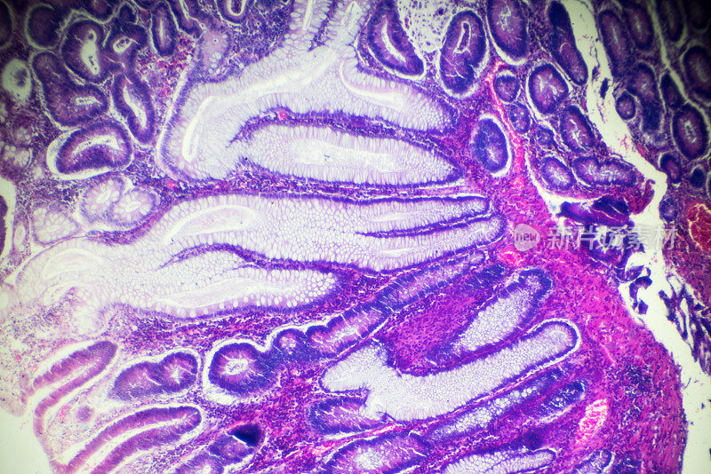 显微镜下的大肠癌(差异很大，管状腺癌)