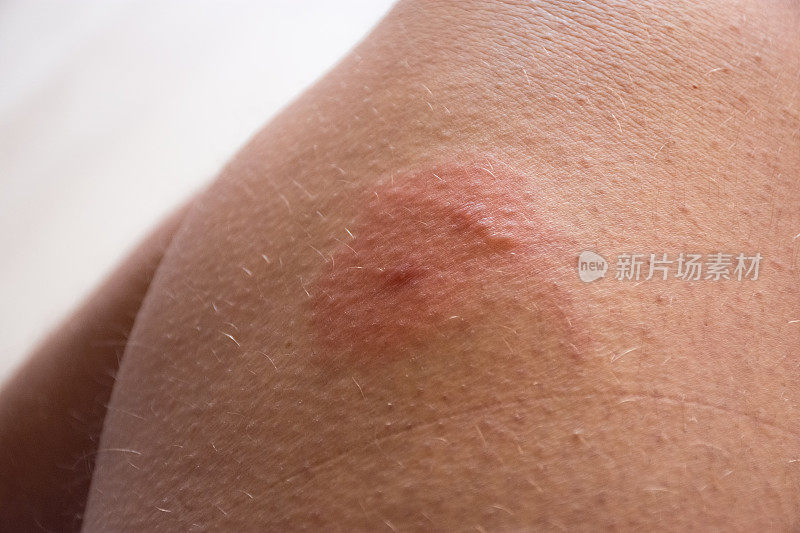 皮肤被昆虫咬伤的照片。双虫叮咬(蜜蜂、黄蜂、马蝇)，皮肤发红、发炎、过敏性肿胀或水肿。虫刺皮肤损伤的迹象和症状