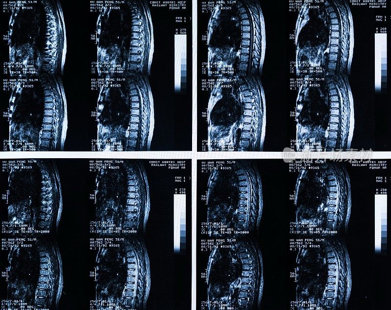 脊柱x射线胶片