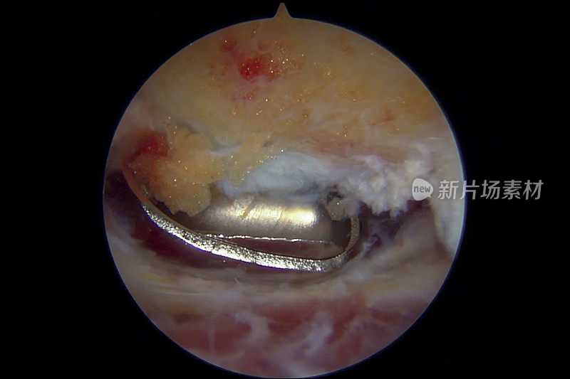 左肩锁关节和软组织切除治疗AC骨关节炎的关节镜视图