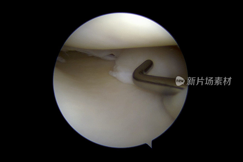 右膝关节内侧室半月板撕裂的关节镜照片