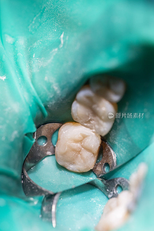 近距离牙髓治疗。清洁牙根及其填充物。现代技术在牙科诊所的概念