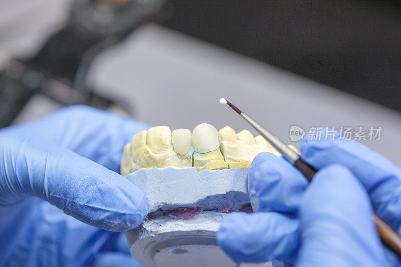 牙科技术人员在他的实验室里将陶瓷植入牙齿的特写
