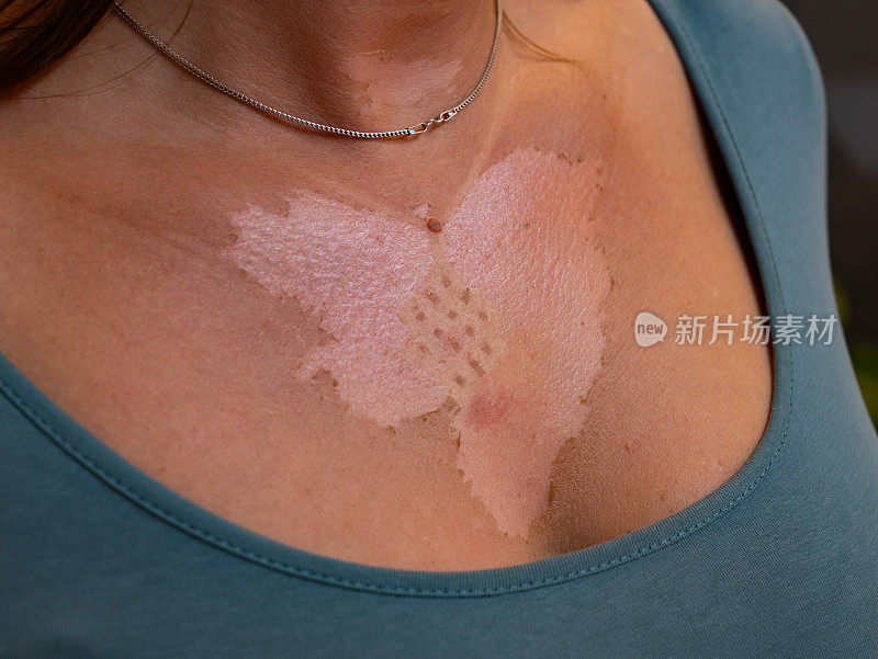 特写，DOF:在危险的晒伤后，一名年轻女子脖子上剥落的皮肤